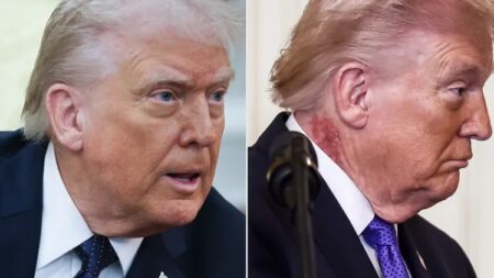 ترامب يواجه طفح جلدي مفاجئ